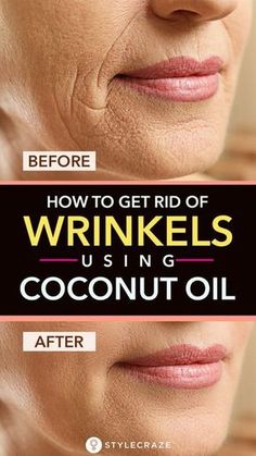 Rid Wrinkles, Natural Aging Skin Care, Get Rid Of Wrinkles, Makeup Tip, Skin Care Wrinkles, Face Wrinkles, Wrinkled Skin, Skincare Tips, Skin Care Treatments