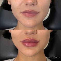 Lip Filler Heavy Upper Lip, Lips Injection, Lip Filler Technique, Eye Lift Surgery, Botox And Filler, Lip Lift, Lips Inspiration, Face Fillers, Danielle Smith