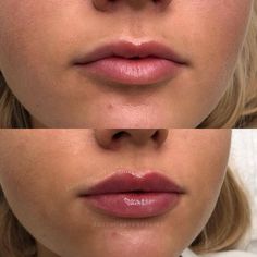 Very Natural Lip Filler, Vermillion Border Lip Filler, Lip Injections Natural, Lip Filler Downturned Lips, Lip Filler Russian Lips, Top Lip Filler Before And After, Natural Lip Injections Before And After, Lip Fillers Natural Look