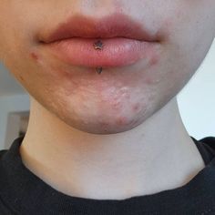 a close up of a person's face with acne on their lip and nose