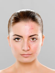 Flawless Makeup for Acne Prone Skin Essential Skin Prep Guide