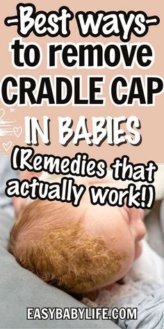 a baby sleeping with the words best ways to remove cradle cap in babies