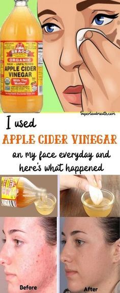 Acv Toner, Cider Vinegar Benefits, Apple Cider Vinegar For Skin, Apple Cider Vinegar Benefits, Vinegar Uses, Apple Cider Benefits, Organic Apple Cider