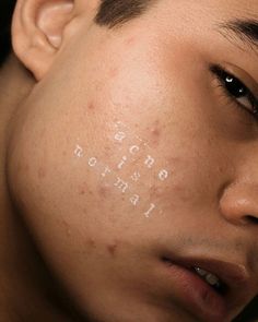 Different Types Of Acne, Real Bodies, Glow Skin, Foto Art, Beauty Standards, Body Love, Perfectly Imperfect, Body Image, Skin Conditions