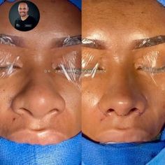 Nose Job Wide Nose, Black Women Nose Job, Thick Nose Rhinoplasty, Rhinoplasty Black Women, Face Plastic Surgery Before After, Black Rhinoplasty, Cosmetic Surgery Aesthetic, Liquid Rhinoplasty Before And After