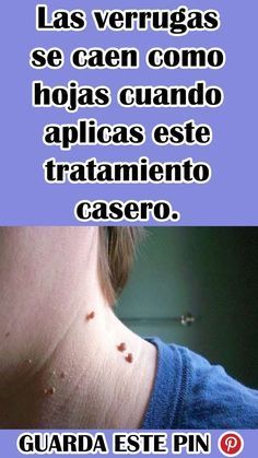 Las verrugas se caen como hojas cuando aplicas este tratamiento casero. Lifting Facial, Cold Sores Remedies, Natural Sleep Remedies, Fashion Crochet, Natural Cold Remedies, Cold Home Remedies, Short Hair Over 60, Lose 40 Pounds, Short Hair With Bangs