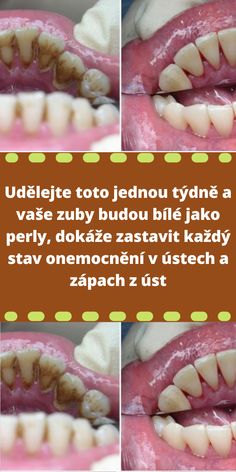 Udělejte toto jednou týdně a vaše zuby budou bílé jako perly, dokáže zastavit každý stav onemocnění v ústech a zápach z úst Pasta, Makeup, Make Up