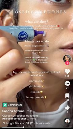 Closed Comedones, Pimple Extractor, Skin Goals, Benzoyl Peroxide, Skincare Tips, Glycolic Acid, Salicylic Acid, Care Tips, Skincare Routine