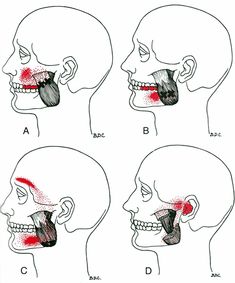 Vondt i kjeven kan skyldes flere årsaker. Inkludert kjevespenninger (muskulære smerter), bruskskade, artrose, TMD syndrom eller meniskskade. Punkty Spustowe, Tmj Relief, Referred Pain, Magic Fingers, Craniosacral Therapy, Jaw Pain, Trigger Point Therapy, Trigger Point