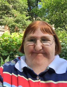 Pin on Life with Systemic Mastocytosis . #Melissa_Blake #Ugly_Photos #Best_Marriage_Advice #Disabled_People