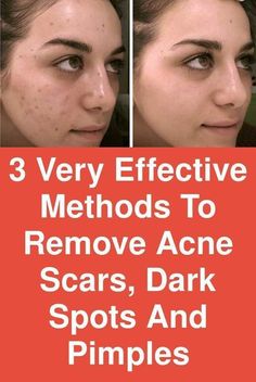 Fast Skin Whitening Tips At Home Doterra Acne, Remove Pimples, Pimple Scars, How To Get Rid Of Pimples, Acne Scar Removal, Spots On Face, How To Remove Pimples, Pimple Marks, Acne Remedies