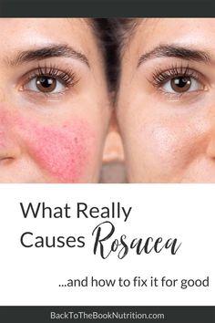 Learn commonly overlooked root causes of rosacea, including poor gut health, histamines, and food sensitivities. Plus, learn how to overcome rosacea naturally! #rosacea #skinhealth #acne | Back To The Book Nutrition How To Stop Redness On Face Skin Care, Skin Care Reduce Redness, How To Cover Up Redness On Face, How To Help Redness On Face, How To Fix Redness On Face, Facial Redness Remedies, Rosatia Remedies, Get Rid Of Redness On Face, Reduce Redness In Face