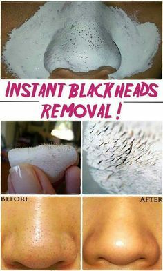 DIY 2 ingredient blackhead removal mask INGREDIENTS: -1 small dry gelatin pack -a few teaspoons of milk DIRECTIONS: By mixing one teaspoon of gelatin with 3 teaspoons of milk, put in microwave for approx 10 seconds. Apply to blackhead areas. Leave on for 15 min. Peel off. Obličejové Masky, Aesthetic Health, Hacks Every Girl Should Know, Blackhead Removal, Remove Blackheads, Get Rid Of Blackheads, Beauty Remedies, Homemade Beauty Products, Blackhead Remover