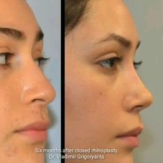 Facial Tips, Facial Fillers, Facial Aesthetics