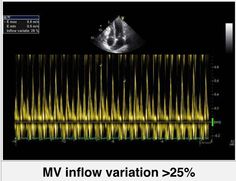 an image of a sound wave with the words vv inflow variation > 25 %