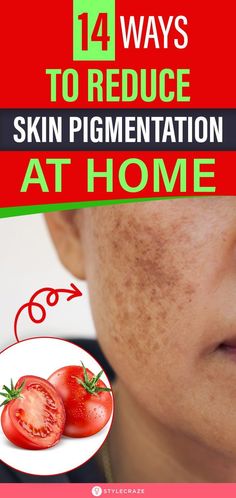 DentaTonic Pigmentation Remedy, Home Remedies For Face, Home Remedies For Bronchitis, Facial At Home, Home Remedies For Skin, Skin Pigmentation, Dry Skin Remedies, Ingrown Toe Nail, Younger Looking Skin