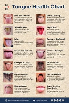 Tongue Health Chart, Tongue Diagnosis Chart, Healthy Tongue, Healthy Teeth And Gums, Health Chart, Dental Health Care, Basic Anatomy And Physiology, Tongue Health, Medical School Essentials