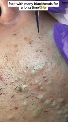 Extration blackhead on a man's face. 😨#ance #blackhead #pimple #pimplepop #viral #comfortable #tiktok How To Heal Popped Pimples Fast, What Causes Blackheads, What Your Pimples Mean, What Do Your Pimples Mean, Pimple Extraction Tool, Green Tea Skin Care, Acne Meme Funny, Cystic Acne Remedies