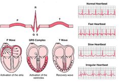 Heart Rhythms Ekg Interpretation, Ecg Interpretation, Respiratory Therapy, Nursing School Notes, Nursing Study, Nursing Education