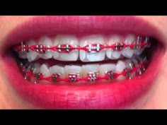 Power Chain Braces, Invisible Teeth Braces, Braces Ideas