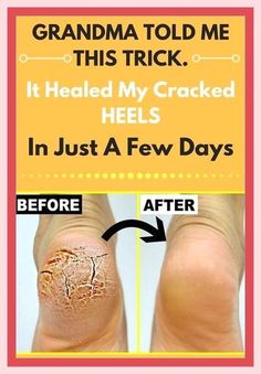 I’m forever grateful. Wonderful info! Cracked Heel Remedies, Unhealthy Diet, Cracked Heels, Homemade Remedies, Healthy Beauty, Simple House, Home Remedies, Baking Soda, Healthy Life