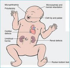 I Am Different, Medicine Student, Small Head, Genetic Disorders, 2nd Baby, Prenatal, Nursing, A Photo