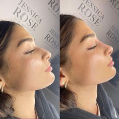 Perfect Nose Profile, Nose Ideas For Nose Job, Button Nose Filler, Cute Noses Woman, Nose Job Ideas, Small Nose Rhinoplasty, Noses For Nose Jobs, Nose Job Nose, Nose Job For Wide Nose