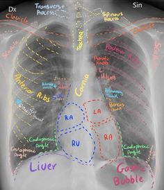 an x - ray shows the location of the lungs in different colors and letters on it