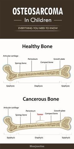 Osteosarcoma In Children - Everything You Need To Know Medical Assistant Student, Mcat Study, Fitness Guide, Tech Startup, Mom Junction, Alternative Therapies, Pediatric Nursing, Nursing Notes, Medical Assistant