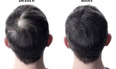 Regrow Hair Naturally, Rapid Hair Growth, Dunner Wordend Haar, Regrow Hair, Lost Hair, Hair Vitamins, Hair Thickening, Hair Regrowth, Hair Transplant