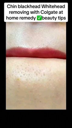 Blackheads And Whiteheads, For Blackheads, Rid Of Blackheads, Face Skin Care Routine, Clear Healthy Skin, Blackheads Removal, Natural Face Skin Care, Diy Skin Care Routine