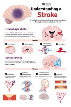 an info sheet describing the different types of strokers and how they are used to treat