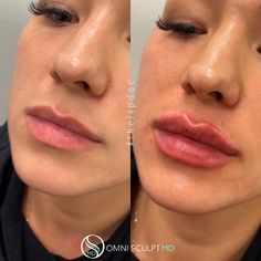 Lip Injection Before & After Gallery | OMNI SCULPT MD