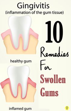 10 Simple Home Remedies For Swollen Gums : Here are 10 of the most effective home remedies to treat and gain relief from swollen gums Swollen Gum, Teeth Health, Receding Gums, Gum Health, Teeth Care, Oral Health Care, Simple Home, Tooth Decay