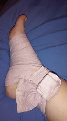 Arm Injury Fake Story, Injured Leg Snapchat, Flower Bouquet Snapchat Story, Fake Injury, Foot Injury, Celebrity Fashion Looks, Sprained Ankle, Emotional Photography, Insta Profile Pic