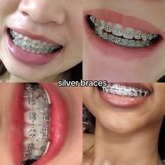 Silver Braces, Darker Skin Tones