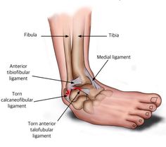 Ankle Injuries Doctor In Andheri | Sprained ankle, Ankle sprain recovery, Ankle exercises Ankle Sprain Recovery, Ankle Workout, Orthopedic Nurse, Ankle Injuries