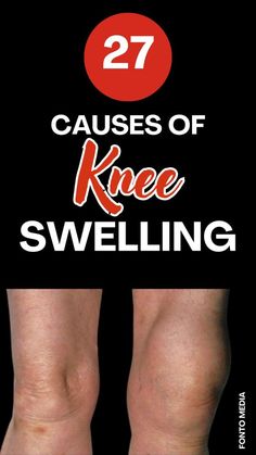 Explore the various causes of knee swelling with this comprehensive list of 27 potential factors. From injuries and arthritis to infections and underlying health conditions, understand the reasons behind knee swelling to better address symptoms and seek appropriate treatment. Empower yourself with knowledge for better knee health! Swollen Knee Remedies, Fluid On The Knee, Knee Pain Remedies, Healing Cavities, Knee Sprain, Knee Swelling, Knee Workout, Knee Pain Relief Remedies, Knee Health