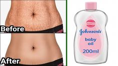 How To Remove Stretchmarks Naturally, Strech Marks Removal At Home, Strech Marks Celebrity, Strech Marks Model, How To Get Rid Of Stretchmarks Fast, Strechmark Remover Skin Care, How To Remove Strechmark, Stretchmark Remover