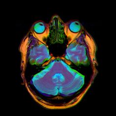 an mri image of a person's head with different colors and patterns on it