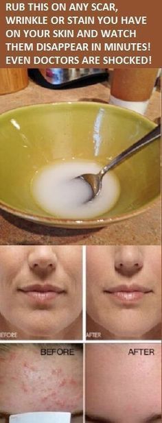 Skin Care Wrinkles, Natural Cold Remedies, Natural Cough Remedies, Peinados Fáciles Para Cabello Corto, Skin Remedies, Skin Care Remedies, Skin Care Recipes, Wrinkle Cream, Natural Home Remedies