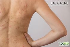 back acne symptoms #AcneCure #acneremedieshomemade