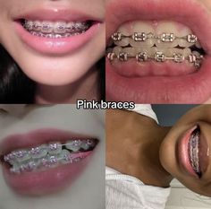 Light Pink Braces Aesthetic, Braced Teeth, Braces Inspo Colors, Pink Braces Black Women, Pink Power Chain Braces, Clear Braces With Color Bands, Light Pink Braces, Hot Pink Braces, Brackets Aesthetic