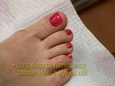 http://www.320-FOOT.com If you're being treated for toenail fungus and don't want to have to wait for months for clear nails to grow in, a Keryflex pedicure ... Acrylic Nails At Home, Acrylic Toe Nails, Acrylic Toes, Toenail Fungus, Clear Nails