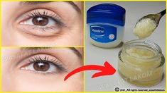 Home Remedy For Bags Under Eyes, What To Do For Under Eye Bags, Essential Oils For Puffy Under Eyes, Best Way To Get Rid Of Bags Under Eyes, Yea Bags For Eyes, Under Eyes Wrinkles Remedies, Vaseline For Under Eye Bags, Natural Eye Bag Remedies, What To Do For Puffy Under Eyes