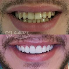 Hollywood Smile, Dental Veneers, Cosmetic Dentistry, Plastic Surgery, Surgery, Hollywood