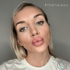 Lip Injection Before & After Gallery | OMNI SCULPT MD