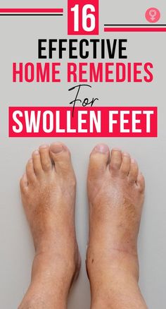 16 Effective Home Remedies For Swollen Feet: It’s time you stop suffering silently and stop treating this as a ‘not serious’ medical condition. A few hours of rest don’t always work in reducing the swelling. Here’s where our article will help you out. #remedies #homeremedies #swollenfeet #health #healthcare #healthcaretips #wellness Swollen Feet Remedies How To Get Rid, Reduce Swelling In Feet Remedies, Swollen Ankles Remedies, Foot Swelling Remedy, Feet Swelling Remedies, Leg Swelling Remedies, Ankle Swelling Remedies, Reduce Swelling In Legs And Ankles, Swollen Ankle Remedies