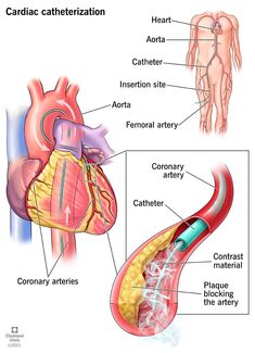 Heart Catheterization, Heart Pressure, Catheter Insertion, Heart Arteries, Chest Discomfort, Medical Pictures