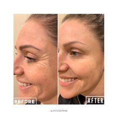 Botox Before After, Botox Face, Botulinum Toxin, Facial Contouring